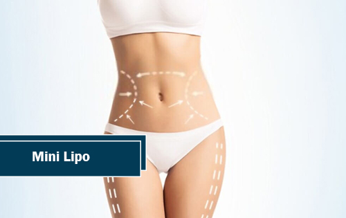 Liposuction with Tickle Lipo | Pinehurst, TX