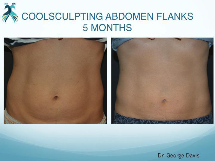Coolsculpting Results Before and After in Woodlands TX