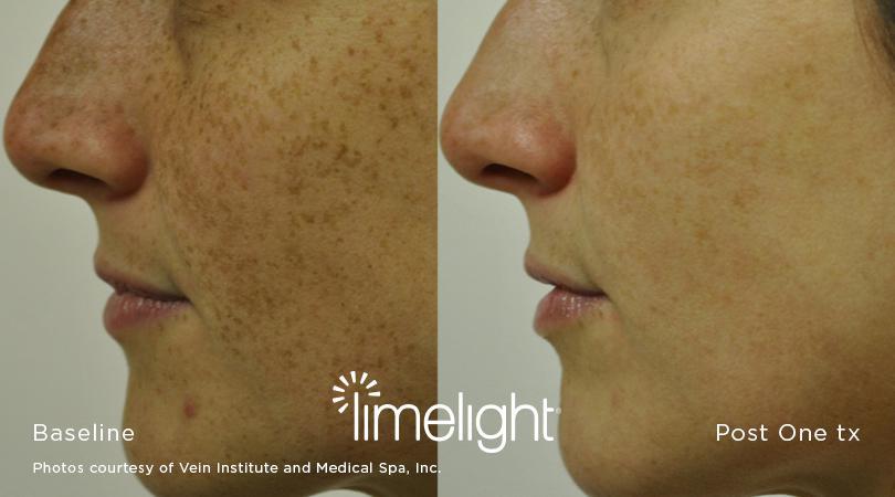 results of laser facial treatment in Woodlands Wellness
