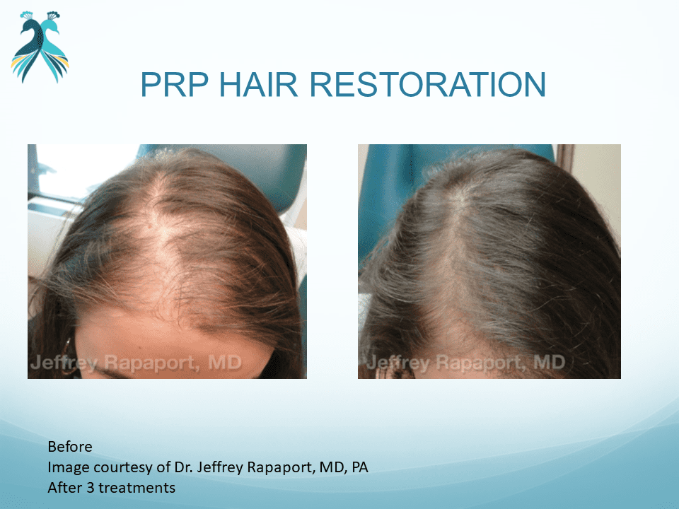Hair restoration with PRP results in Woodlands TX - before and after