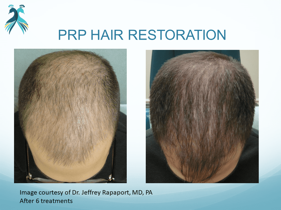PRP hair loss treatment results before and after