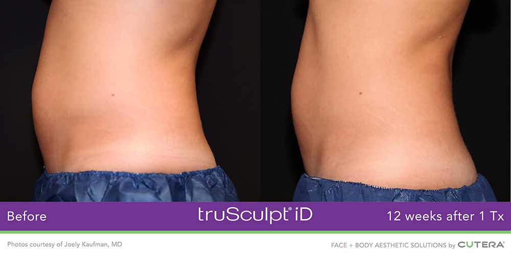results of body sculpting and fat reduction in Woodlands TX