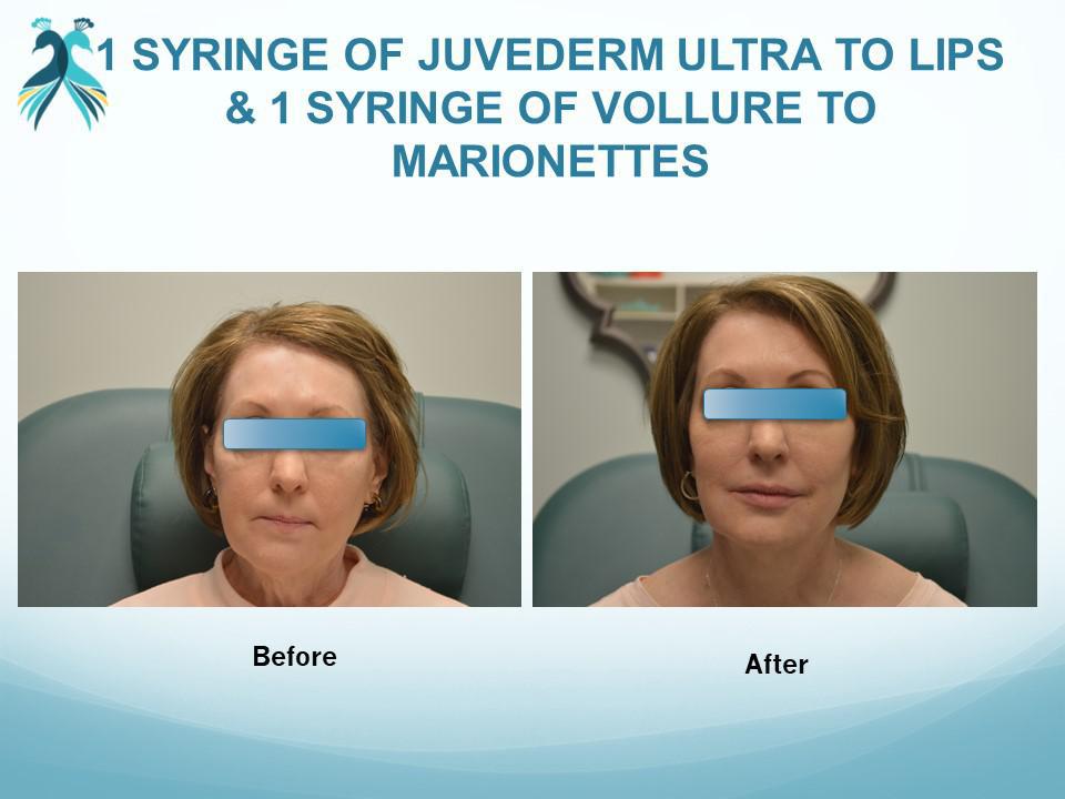 Juvederm results in Woodlands TX - Before & After pictures