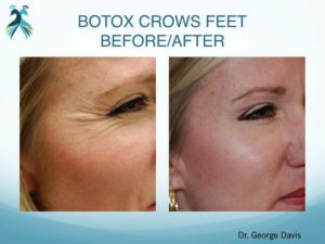 Botox Woodlands TX Botox results in Woodlands TX - Before & After pictures