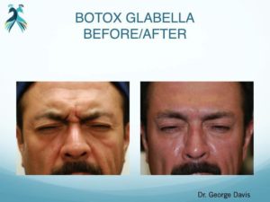 Botox Woodlands TX Botox results in Woodlands TX - Before & After pictures