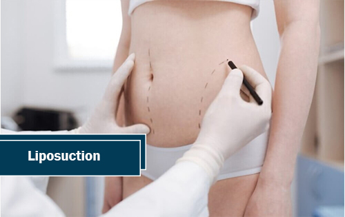 Liposuction | Woodlands, TX