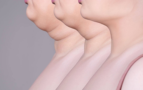 Double Chin Removal | Woodlands, TX