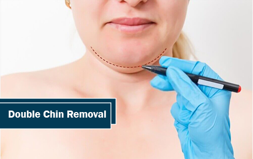 double chin fat removal in Woodlands TX