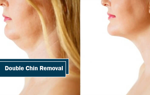 Double Chin Removal The Woodlands TX
