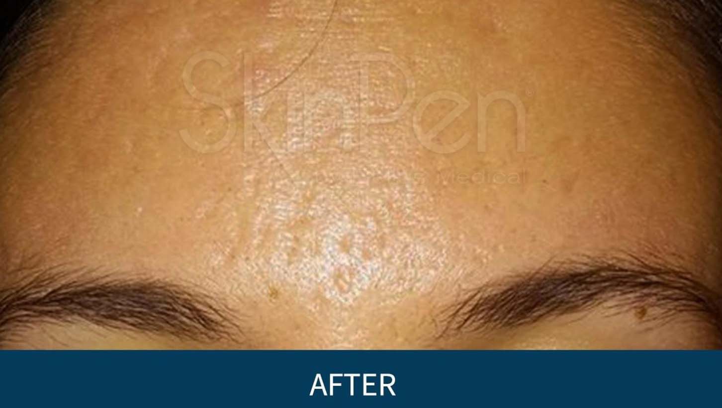 Acne Scar Removal Woodlands TX Acne Scar Removal Before & After Results