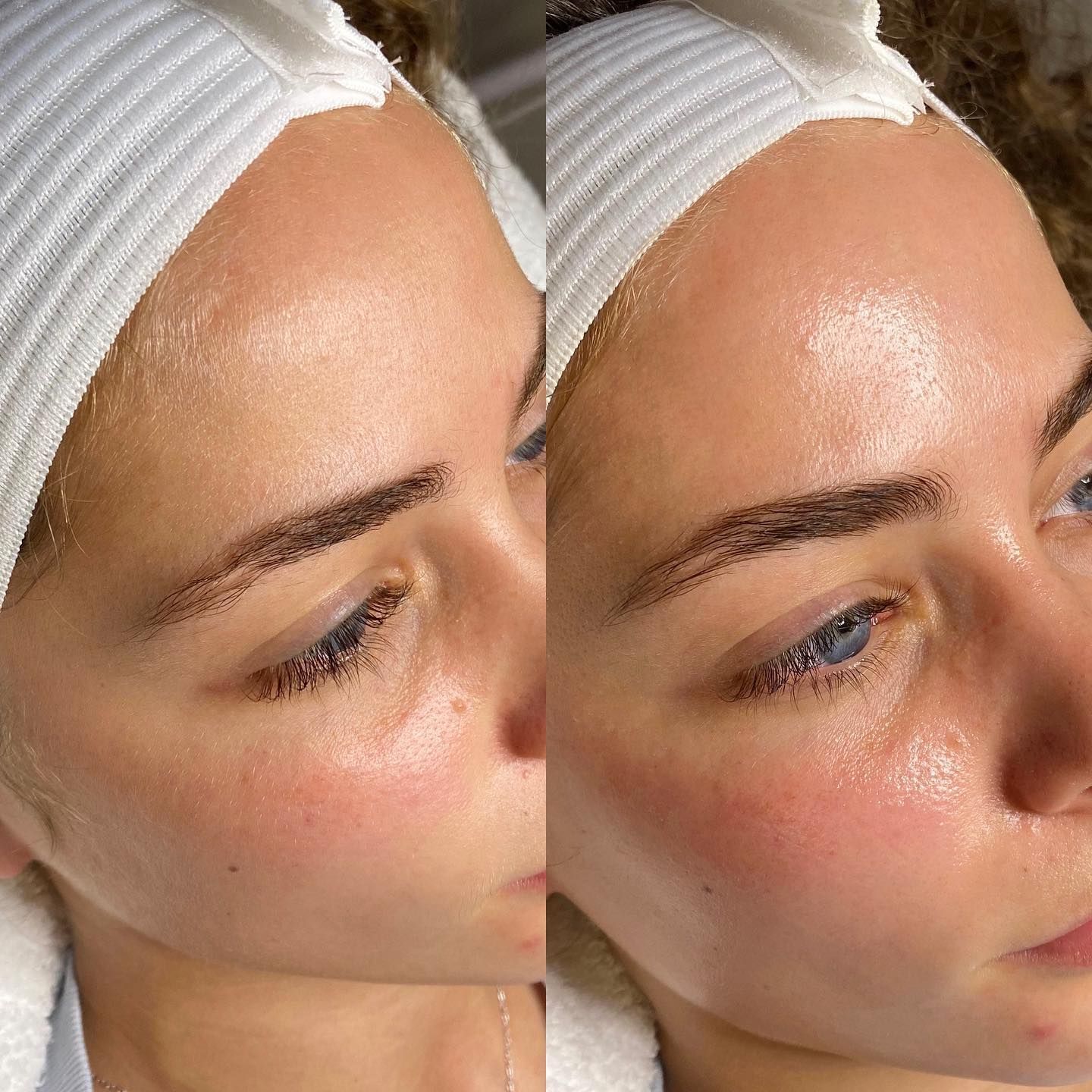 Dermaplane facial results - before and after - Woodlands TX
