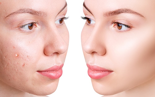 Acne Scar Removal Woodlands TX