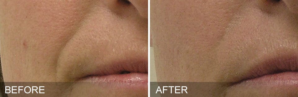 HydraFacial Woodlands TX
