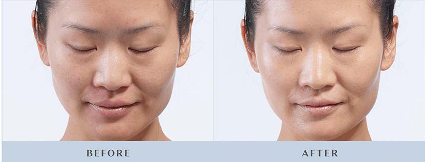 Diamond Glow Treatment - Woodlands TX