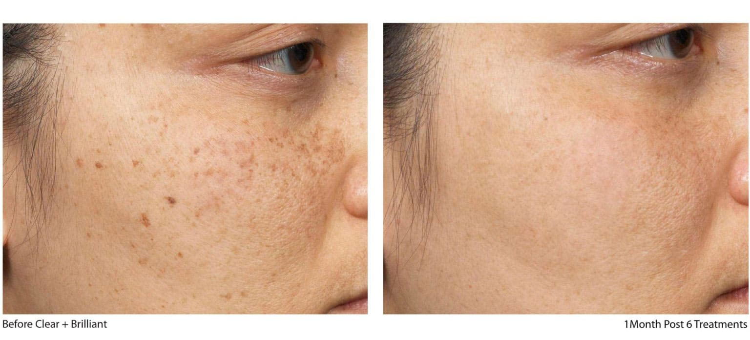 sun spots removal Woodlands TX