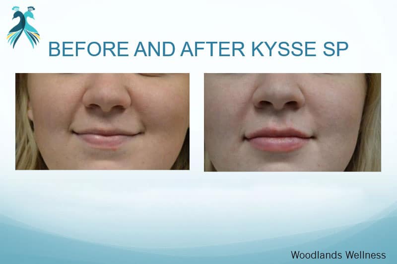 lips enhancement before and after