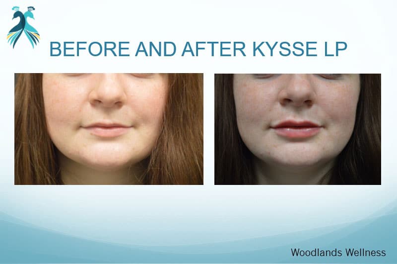Lips enhancement in Woodlands TX - before and after
