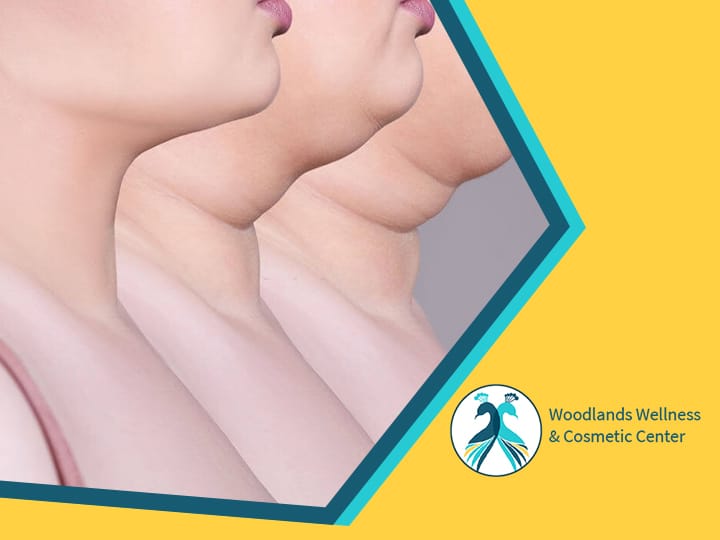 Double Chin Removal The Woodlands TX