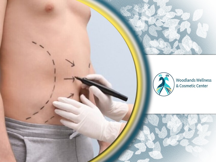 Liposuction Woodlands TX