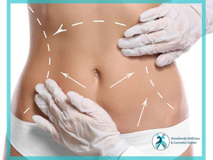 Liposuction Woodlands TX