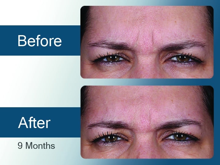 Daxxify Before & After Results