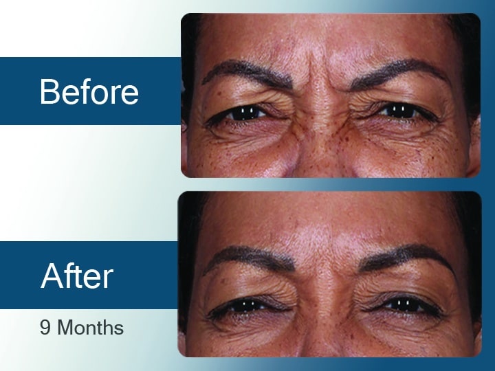 Daxxify Before & After Results
