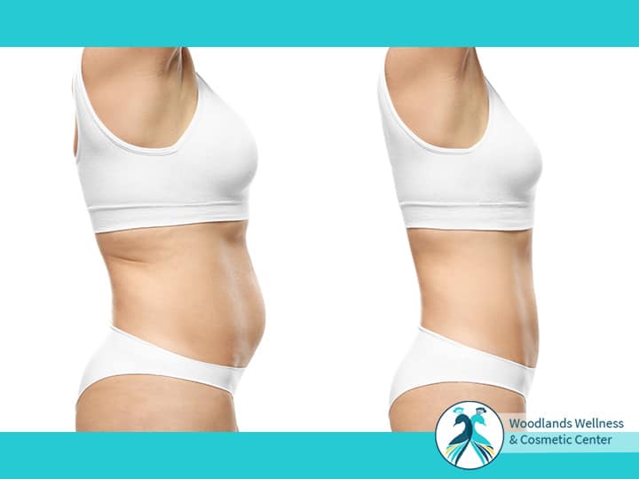 Liposuction Woodlands TX